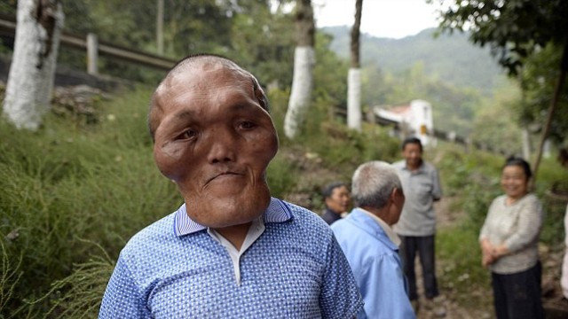 Milyonda bir görülen hastalık bağış toplayamazsa... - Resim: 1