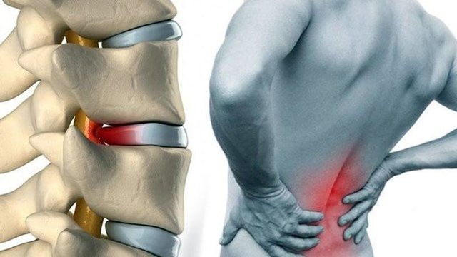 Bel ağrısını önlemek için bunları yapın - Resim: 1