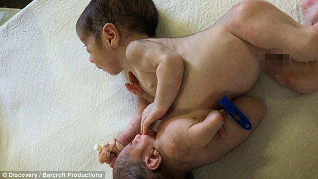 Milyonda bir rastlanan bebek - Resim: 1