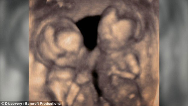 Milyonda bir rastlanan bebek - Resim: 2