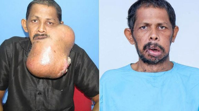 Yüzünden kilolarca tümör alındı! - Resim: 1