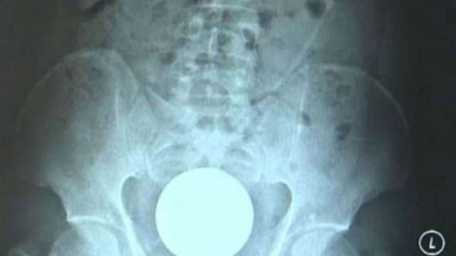 Eğlence için anüsüne öyle bir şey soktu ki hastanelik oldu! - Resim: 1