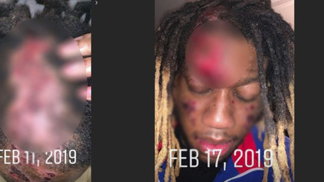 Ünlü şarkıcı et yiyen bakteri kaptı! Yüzünü yemeye başladı hızla yayılıyor - Resim: 2