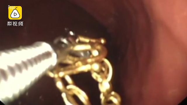 Midesinden çıkan mücevheri doktorları şoke etti - Resim: 2