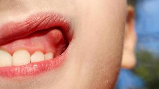 Dişte apse neden olur nasıl geçer? - Resim: 3