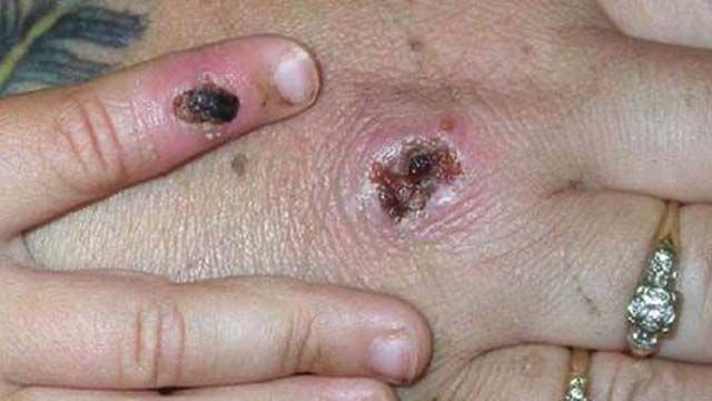 Yeni Kabus! Maymun Çiçeği hastalığı paniği nasıl bulaşıyor, tedavisi var mı? ABD ve İngiltere'ye sıçradı - Resim: 4