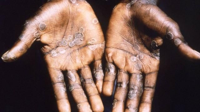 Maymun çiçeği virüsü yayılmaya devam ediyor: Bir ülkede daha görüldü - Resim: 3