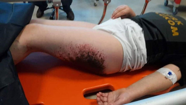 Afyonkarahisar'da okul bahçesinde kar topu oynayan öğrencilerin vücutlarında yanıklar oluştu - Resim: 0