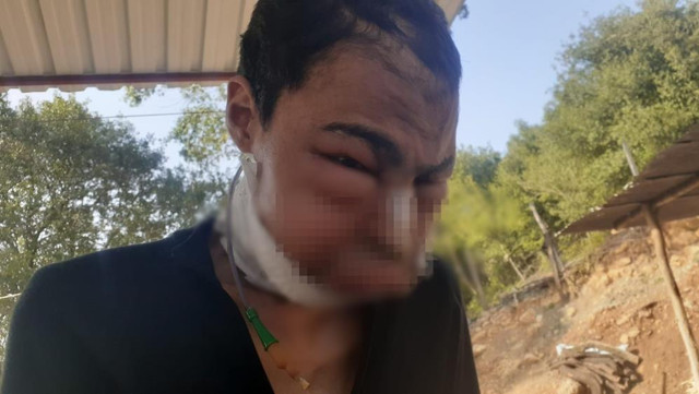 Dilinin altında çıktı çenesini kestiler! Hüseyin'den acı haber geldi - Resim: 1