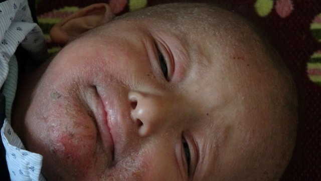 Evde soba yanınca balık kokusu yayan çocuk! Minik Taha'nın eşi benzeri görülmemiş hastalığı - Resim: 1