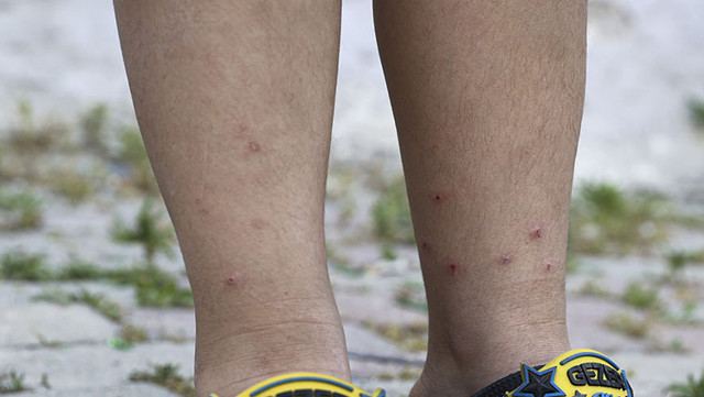 Şikayetler patladı İstanbul'da sivrisinekler hastanelik etti! Bu ilçelerde yaşayanlar dikkat "Isırmıyor resmen koparıyor" - Resim: 0