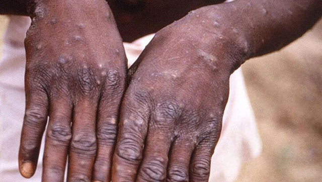 Dünya Sağlık Örgütü'nden ürküten açıklama: En yüksek seviyeye ulaştı - Resim: 1