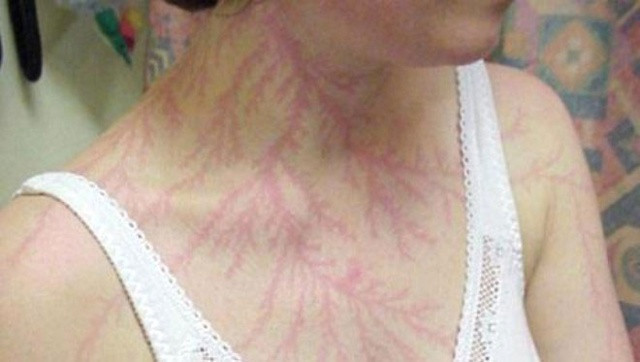 Yıldırımın çarptığı insana ne olur? - Resim: 4