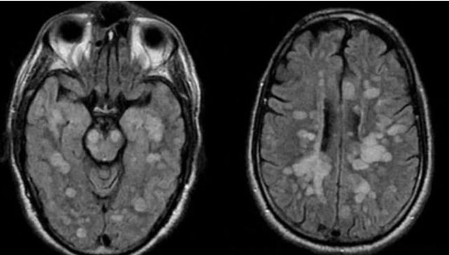Koronavirüs 8 yaşındaki çocuğu felç etti! Doktorlar 'yayılıyor' diye uyardı - Resim: 1