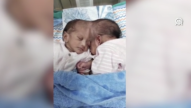 Başkan Erdoğan talimat vermişti! Türkiye'ye getirilen Pakistanlı yapışık ikizler 14 saatlik operasyonla ayrıldı - Resim: 0