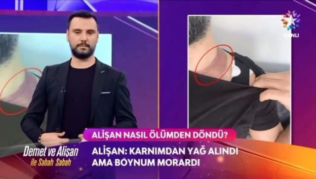 Alişan estetik yaptırırken ölümden nasıl döndüğünü itiraf etti başına gelenler şoke etti - Resim: 3