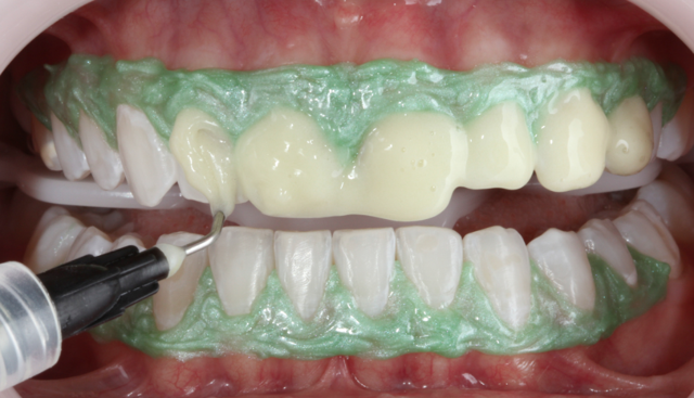 Diş beyazlatmak kanser yapar mı? Uzmanlar net konuştu - Resim: 0