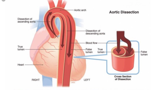 Uzmanı uyardı! Aort yırtılmasında acil müdahale ölüm riskini azaltıyor - Resim: 1