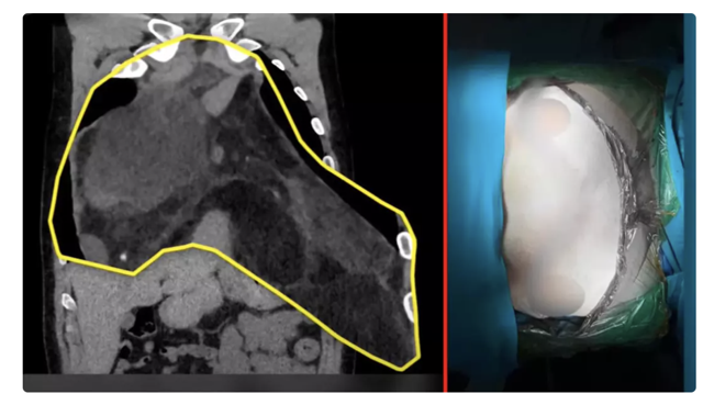 Türkiye'de bilinen en büyük vaka! Kendisi de doktorlar da inanamadı: "Şok geçirdim" - Resim: 0