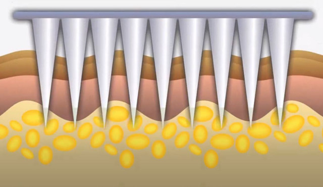 İğneden korkanlara deri bantıyla koronavirüs aşısı! İngiltere'de deneyler başladı - Resim: 1