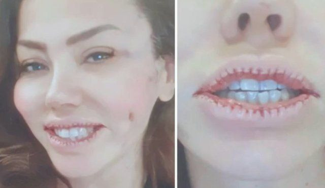 Herkes büyültürken o küçültmüştü! Lara estetikten bin pişman ağlayarak anlattı - Resim: 2