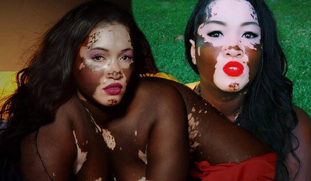 Vitiligolu model isyan etti! 'Ne yani böyleyim diye ölmem mi gerekiyor?' - Resim: 1