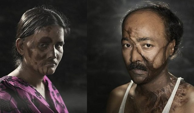 Asit saldırısı kurbanları... - Resim: 1