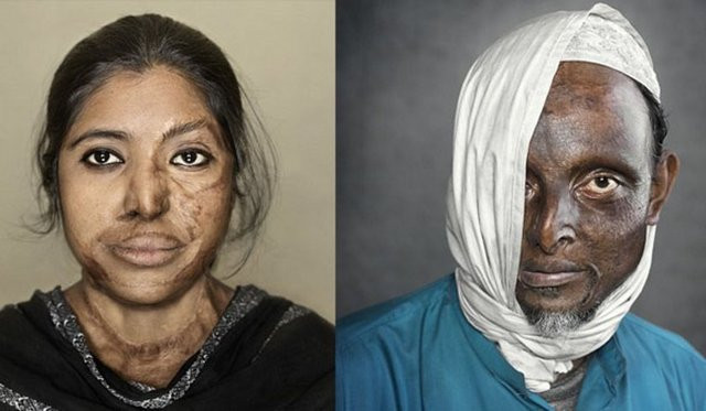 Asit saldırısı kurbanları... - Resim: 2