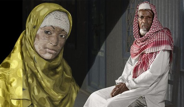 Asit saldırısı kurbanları... - Resim: 3