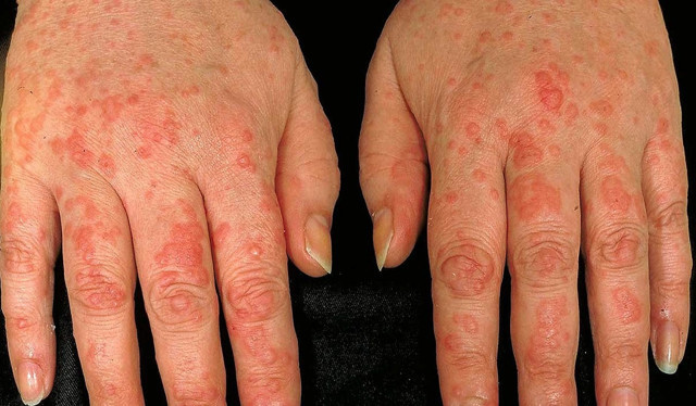 Prof. Dr. Nilgün Atakan: Her 4 kişiden birinde ürtiker hastalığı görülüyor - Resim: 1