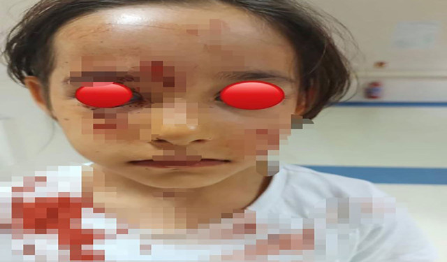 Esenyurt'ta başıboş köpek 6 yaşındaki kızın yüzünü parçaladı! - Resim: 0