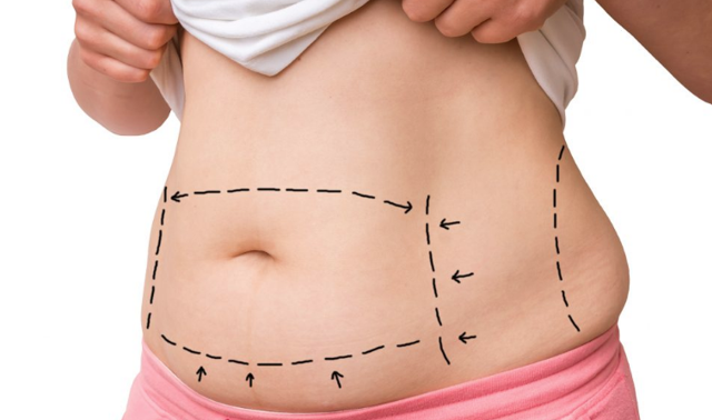 Polikistik over nedir her 10 kadından 1'inde görülüyor - Resim: 1