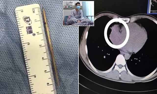 Yuttuğu kürdan kalbinden çıktı tıp dünyası şoka girdi!  - Resim: 3