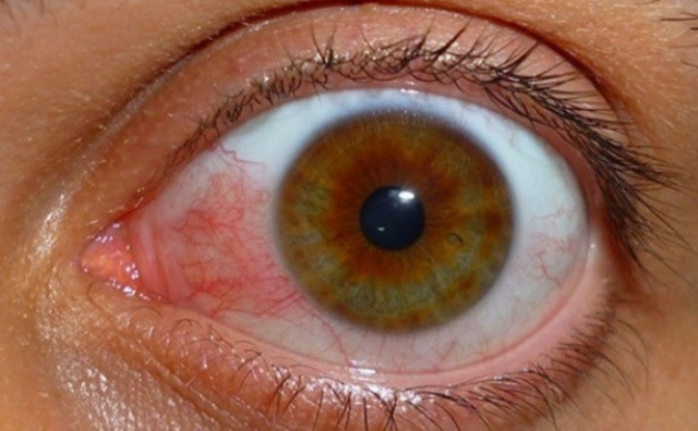 Gözünüzde leke varsa dikkat! - Resim: 1