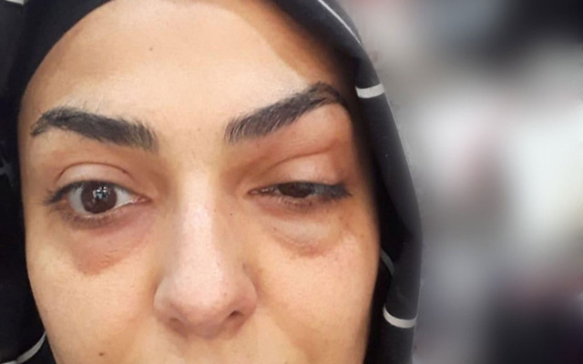 Göz çevresine botoks yaptıran talihsiz kadın az kalsın gözünden oluyordu - Resim: 0