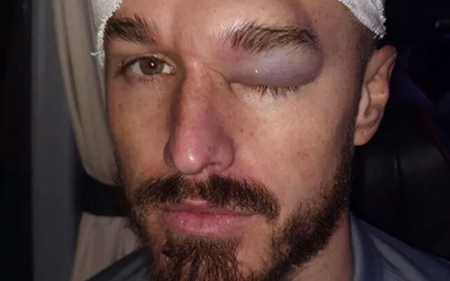 Joe Bennett hastanelik oldu! Yüzü tanınmaz hale geldi - Resim: 0