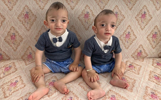 Adıyaman'da ikiz kardeşlerin sağlığı olacakları ameliyata bağlı aile yardım istiyor - Resim: 0