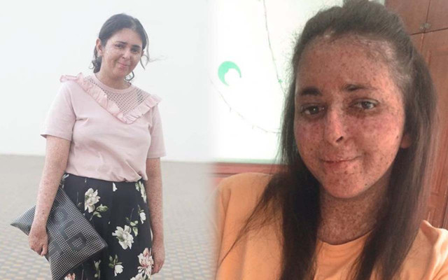 Fas'ta 20 yıldır güneş yüzü görmedi! Nadir görülen hastalık sebep oldu - Resim: 0