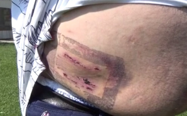 40 dikiş atılan adamın psikolojisi bozuldu Antalya'da otelde kabusu yaşadı - Resim: 2