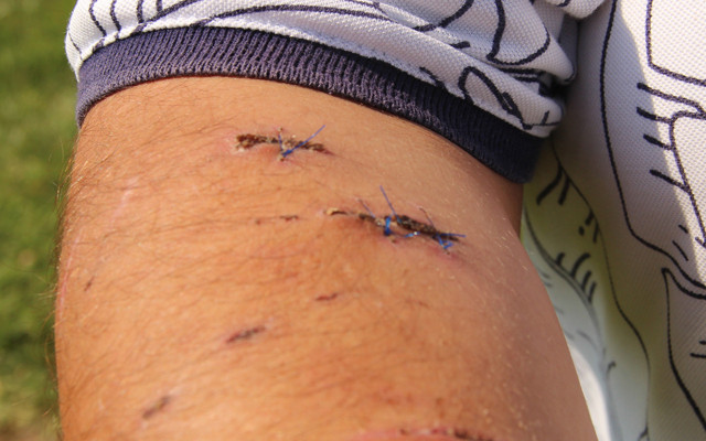 40 dikiş atılan adamın psikolojisi bozuldu Antalya'da otelde kabusu yaşadı - Resim: 0