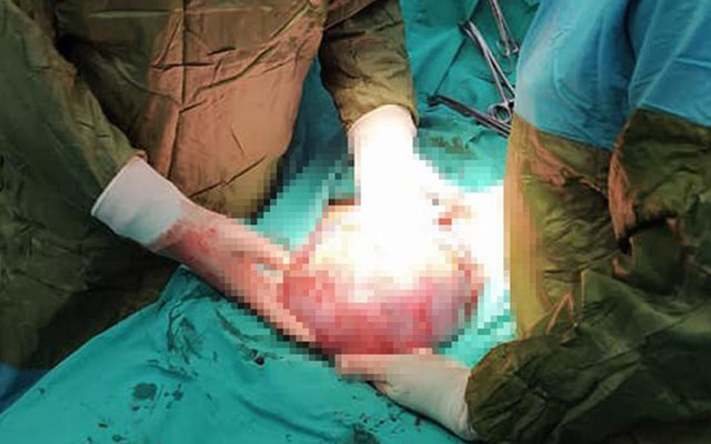 4 kilo ağırlığında futbol topu büyüklüğünde Gaziantep'te dev kitle böyle çıkartıldı - Resim: 1