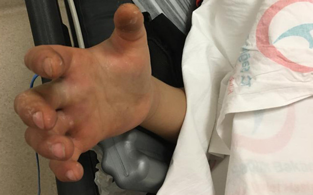 Şanlıurfa'da 13 yaşındaki Civan, engerek yılanı tarafından ısırıldı - Resim: 0