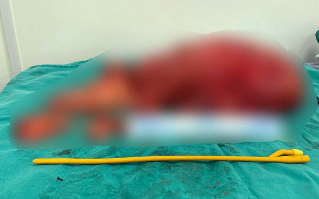 Doktor, hastanın karnından 14 kilo tümör çıkardı! Bu uyarılara kulak verin - Resim: 0