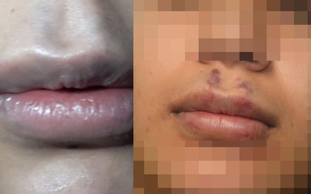 Eskişehir'de botoks faciası: Arkadaşı başını yaktı dudakları çürümeye başladı - Resim: 1