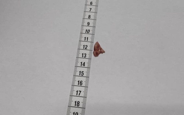 Gaziantep'te gözünde bir cam kırığıyla yaşadı! Hastane hatası yüzünden gözünden oldu - Resim: 0