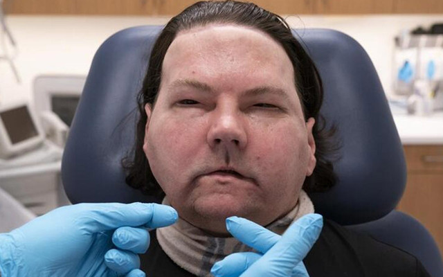 Dünyanın ilk eş zamanlı çift el ve yüz naklinde mucizevi sonuç! - Resim: 0