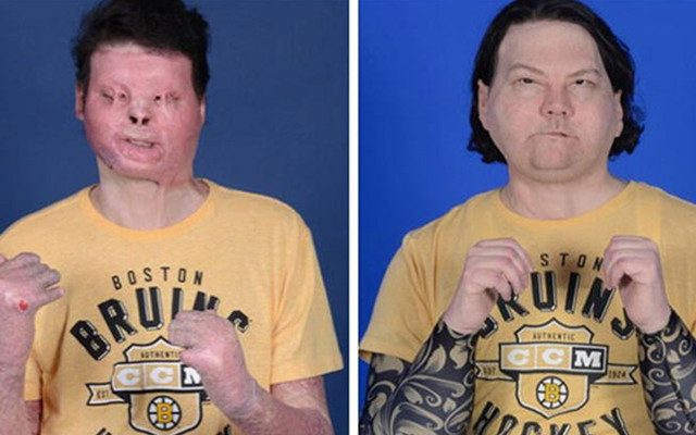 Dünyanın ilk eş zamanlı çift el ve yüz naklinde mucizevi sonuç! - Resim: 1