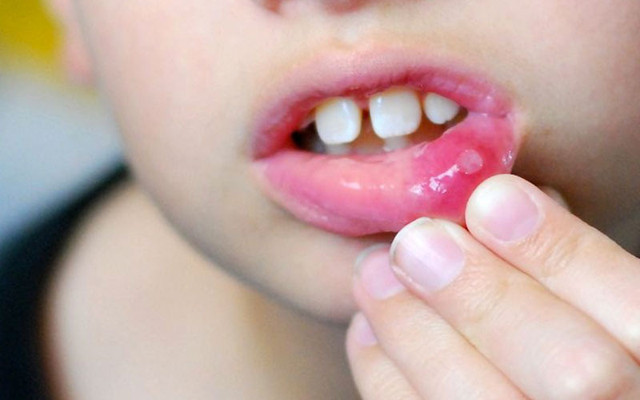 Ağızda aft nasıl geçer karbonat ve tuzlu su formülü pamukçuk için birebir - Resim: 0