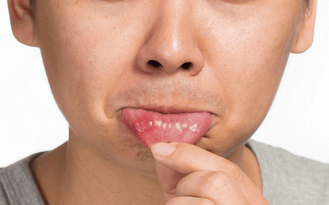 Aft neden çıkar afta iyi gelen Saraçoğlu formülü ağızdaki beyaz yaraları iyileştirir - Resim: 0