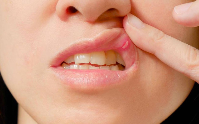 Aft nasıl kaç günde geçer afta ne iyi gelir? Ağız yarasının dermanı karbonat - Resim: 0